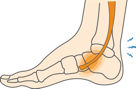 Understanding Posterior Tibialis Tenosynovitis - An Tâm