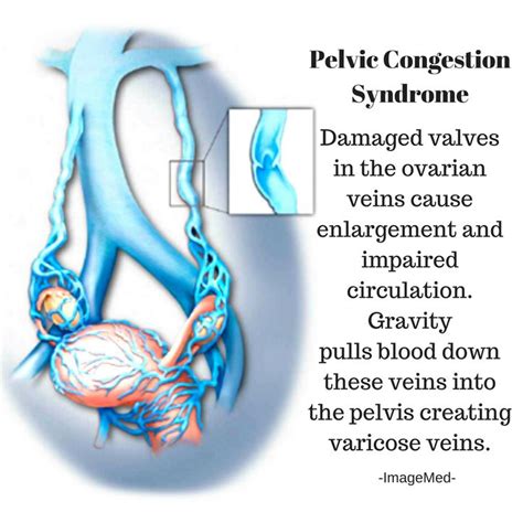 Pin on Pelvic Congestion Syndrome