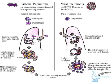 Pneumonia Classification