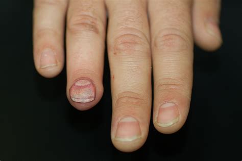 fingernail problems pictures - pictures, photos