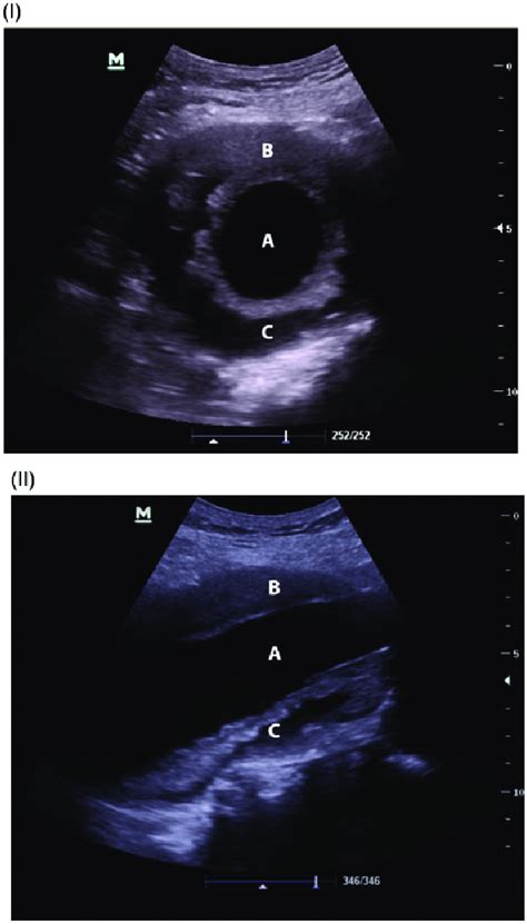 Appearance on ultrasound. (I) Transverse view of an AAA. (II)... | Download Scientific Diagram