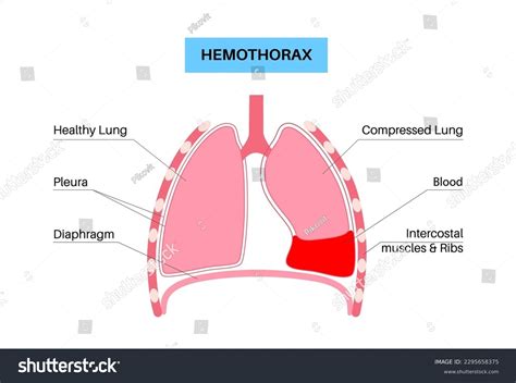 Hemothorax Diseaseblood Collects Pleural Cavity Lungs Stock Vector ...