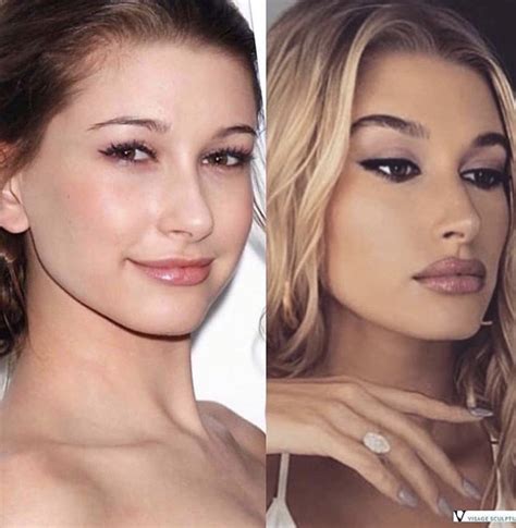 Hailey Bieber in 2020 | Celebrity plastic surgery, Celebrity skin, Lip ...