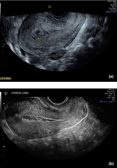 Endometritis Ultrasound