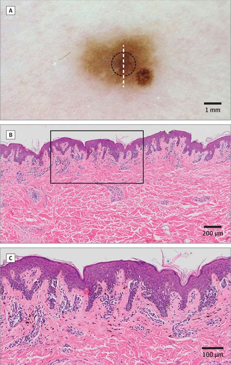 BRAF Wild-Type Melanoma in Situ Arising In a BRAF V600E Mutant Dysplastic Nevus | Genetics and ...