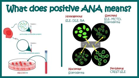 Antinuclear Antibodies (ANA) test and their patterns | ANA test | What does ANA test positive ...