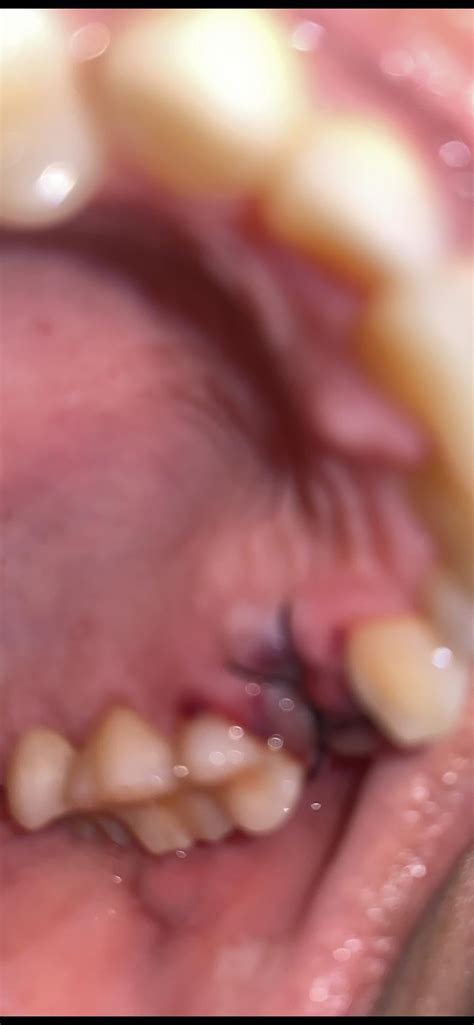 Help! Tooth extraction and bone graft. Is this healing process normal? No pain! : r/Teeth