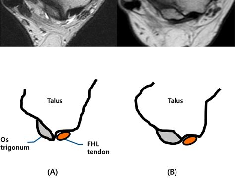 Different types of os trigonum. (A) Type I os trigonum with intact FHL... | Download Scientific ...