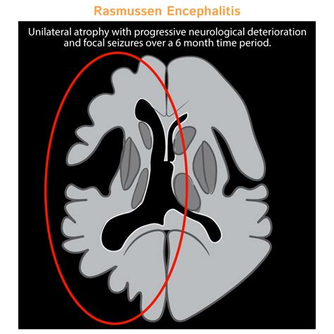 Neurological System Glossary: Rasmussen Encephalitis | ditki medical ...