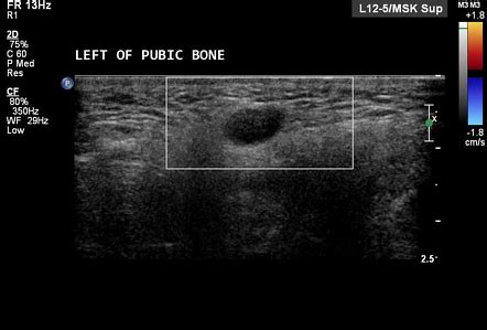 Hydrocele of the canal of Nuck | Radiology Reference Article | Radiopaedia.org