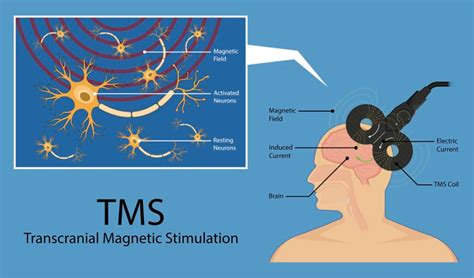 transcranial magnetic stimulation meaning - Mightiest Forum Miniaturas