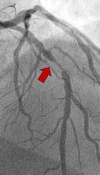 Intra > Conditions and diseases > Interventional cardiology > Coronary ...