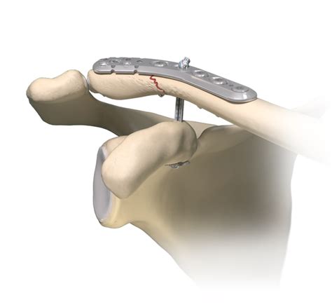 Arthrex - Clavicle Fracture Implants
