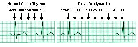 Learning how to read electrocardiograms (EKGs)