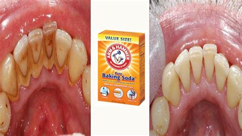 How to Remove Plaque & Tartar from Teeth with Baking Soda at Home - YouTube