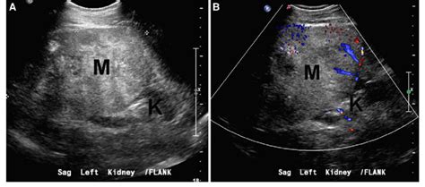 Abnormal Liver Ultrasound