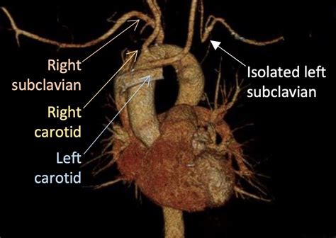 SAVS - Carotid-subclavian bypass for left arm ischemia due to a right ...