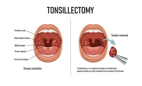 Tonsillectomy Explained | North Carolina Specialty Hospital