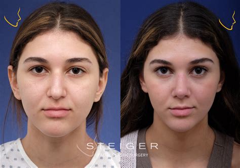 Rhinoplasty Before and After Photos