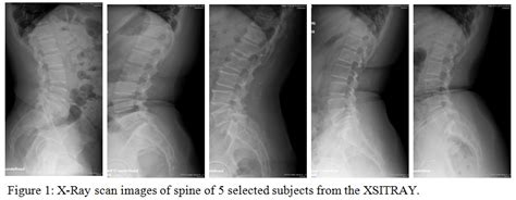 XSITRAY: A Database for the Detection of Osteoporosis Condition | Biomedical and Pharmacology ...