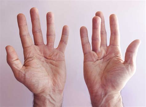 Dupuytren's contracture - Causes, Diagnosis and Treatment