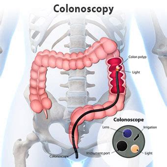 New idea for Colonoscopy Preperation - Trust In The Process