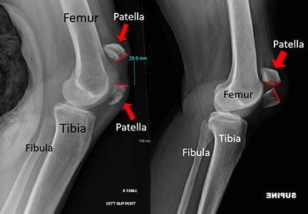 Patella Fracture (Broken Kneecap) | Orthopaedic Trauma Association (OTA)