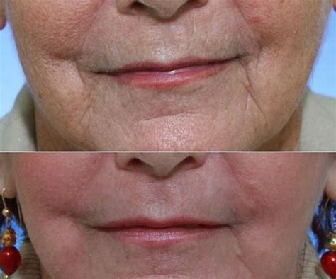 Yoga For The Face Regimens For Men And Women: Dealing With Marionette Lines By Doing Facial ...