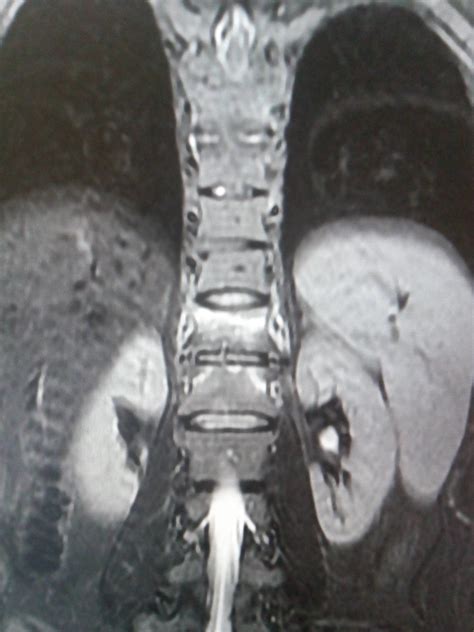 Ankylosing Spondylitis: MRI - Sumer's Radiology Blog