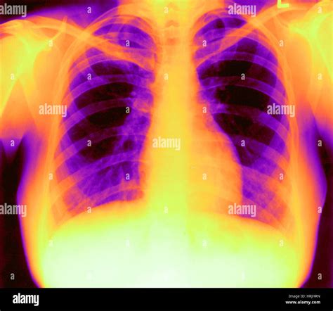 X-ray of Heart and Lungs Stock Photo - Alamy