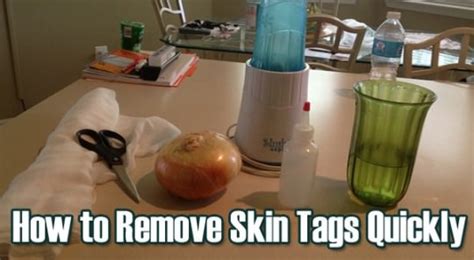 14 Home Remedies for Skin Tag Removal Naturally