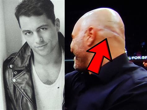 Joe Rogan Hair Transplant Failure! Here's what went wrong!