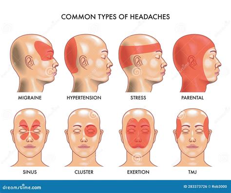 Headache Types Vector Illustration | CartoonDealer.com #275850386