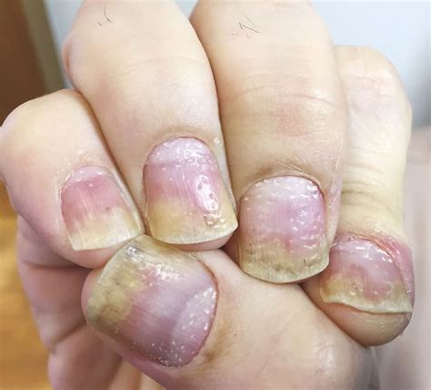 Nail Pitting in Psoriasis | Pitted nails, Psoriasis, Nails