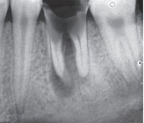 Periapical cyst associated with a carious tooth. - MEDizzy