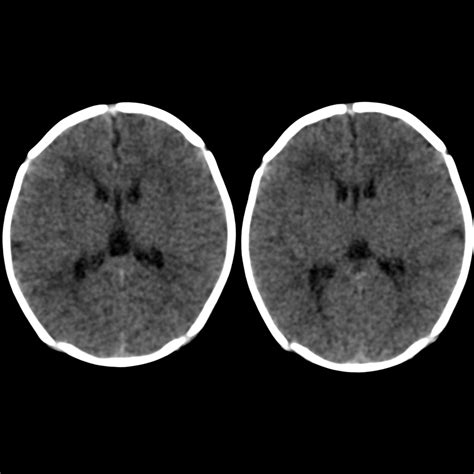 Cavum Vergae | Pediatric Radiology Reference Article | Pediatric ...