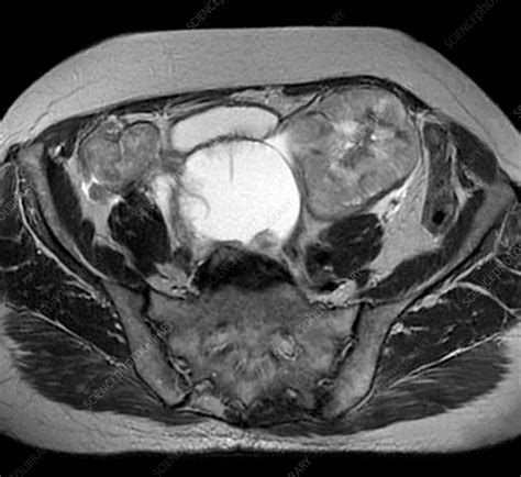 Bilateral ovarian cancer, MRI scan - Stock Image - C034/5656 - Science Photo Library