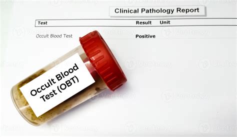 Stool sample container for occult blood test or OBT with abnormal patient's report. 15605365 ...