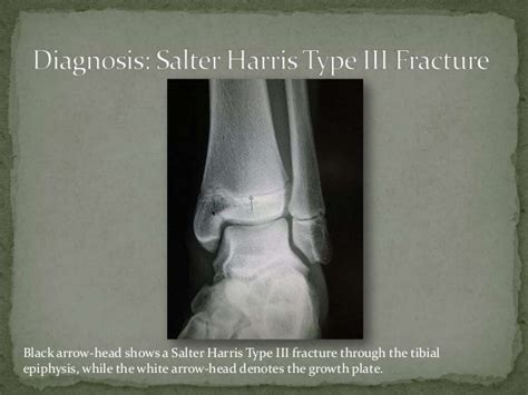 Salter Harris Type 3 Fracture