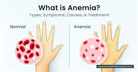 What All You Need to Know About Anaemia? - Brookefield Hospital