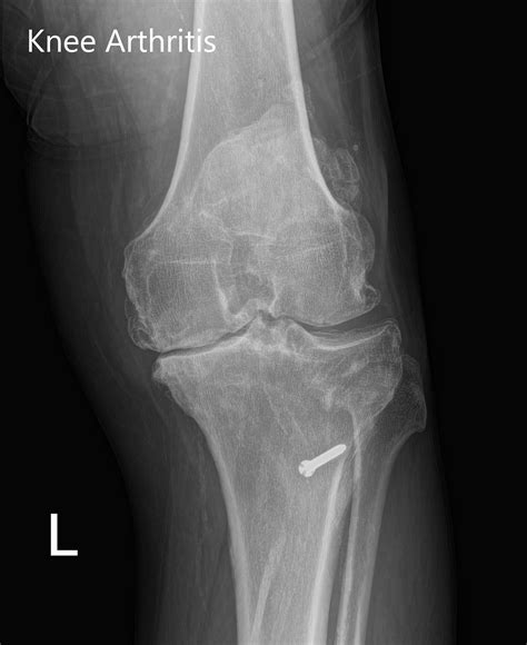 Case Study: Custom Left Knee Replacement in 59 yr. Old Female