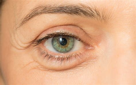 Puffy Eyes: Triggers, Treatments & Foods To Eat/Avoid – SkinKraft