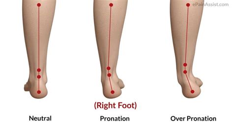 Foot Pronation: Underpronation & overpronation explained- The Foot Clinic