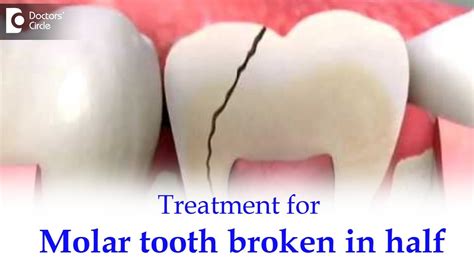 Broken Molar No Pain