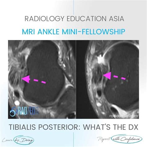 TIBIALIS POSTERIOR TENDINITIS TENDINOPATHY TEARS RADIOLOGY MRI (VIDEO) - Radedasia