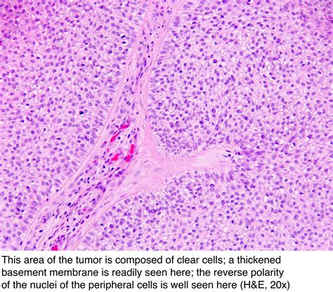 Pathology Outlines - Trichilemmoma