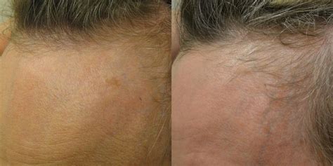 Topical Minoxidil (Females) Before & After Photos - Hair Restoration of the South - New Orleans, LA