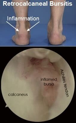 Subcutaneous Calcaneal Bursitis