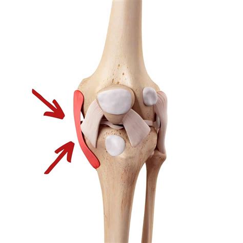 MCL Tear Treatment in Dallas & Frisco | SPORT Orthopedics | DFW