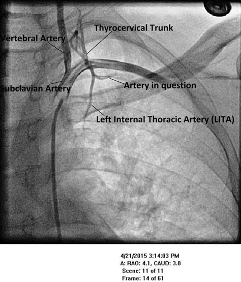 When images lie: a variant of suprascapular artery found incidentally ...